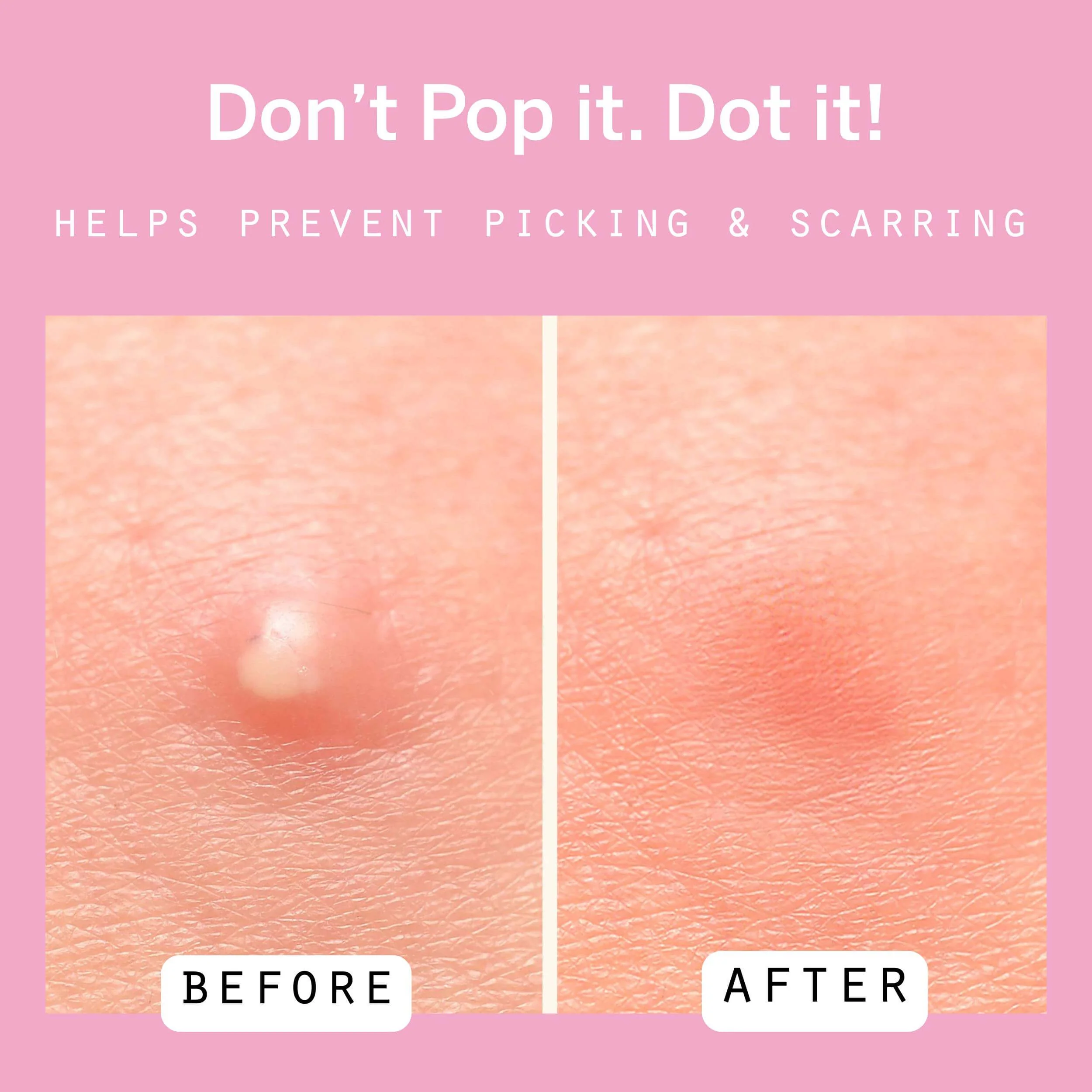 Dot Pimple Patches - Image 4